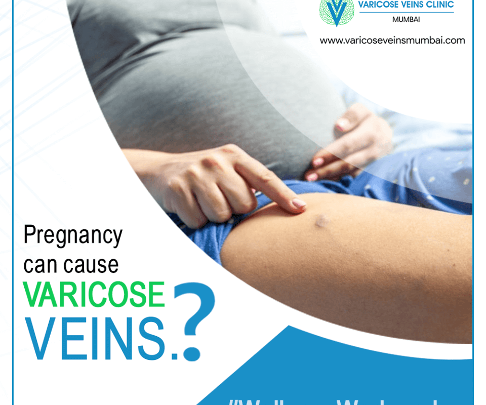 varicose veins during preganancy