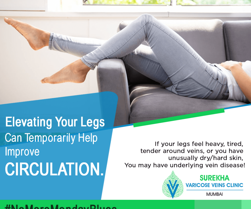 varicose veins 1