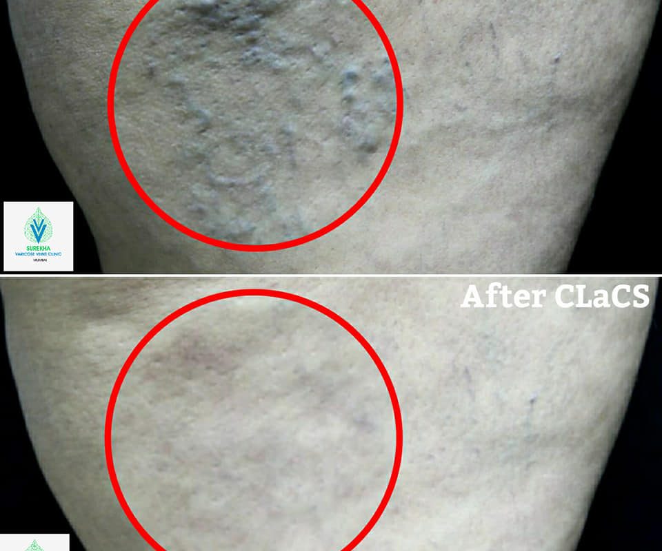 Legs Vein Treatment in panvel