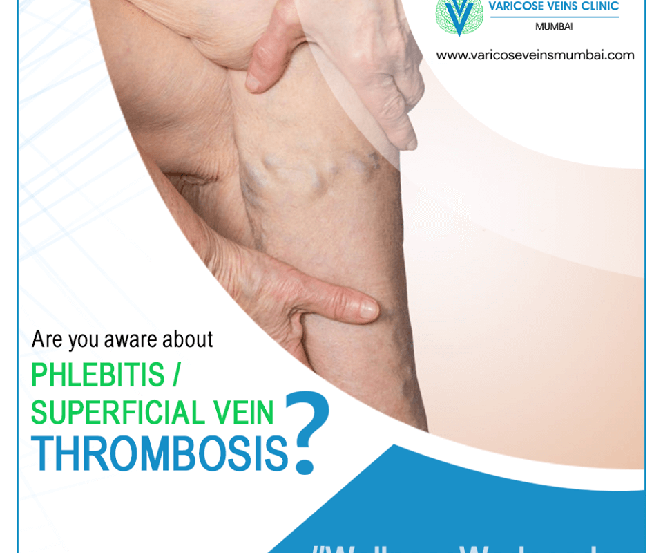 varicose veins treatment in Panvel