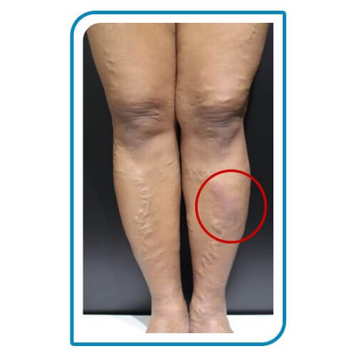 varicose foot reviews simptome tratament