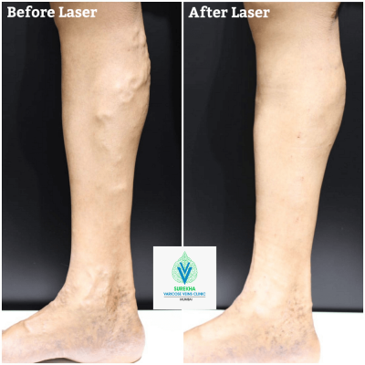 varicose veins laser treatment