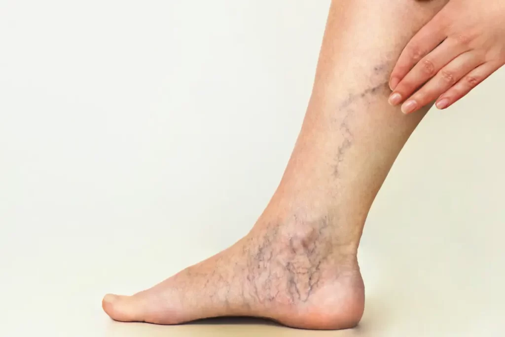 Preventing Spider Veins: Lifestyle Changes and Tips for Better Vascular Health