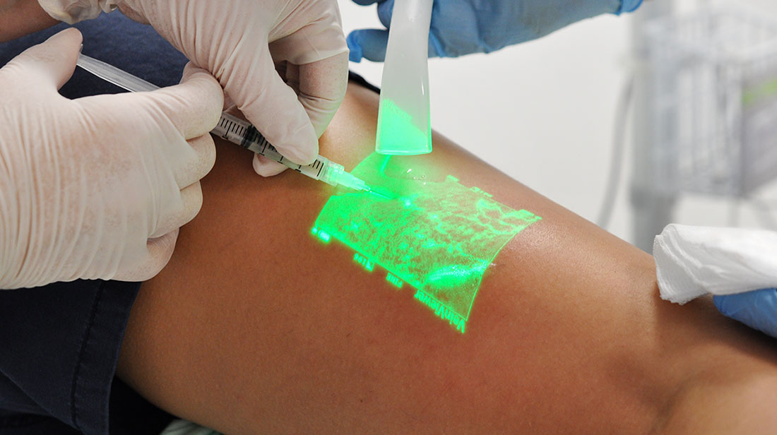 Spider veins treatment in Mumbai