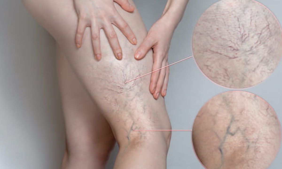 Varicose vein treatment in Dombivli