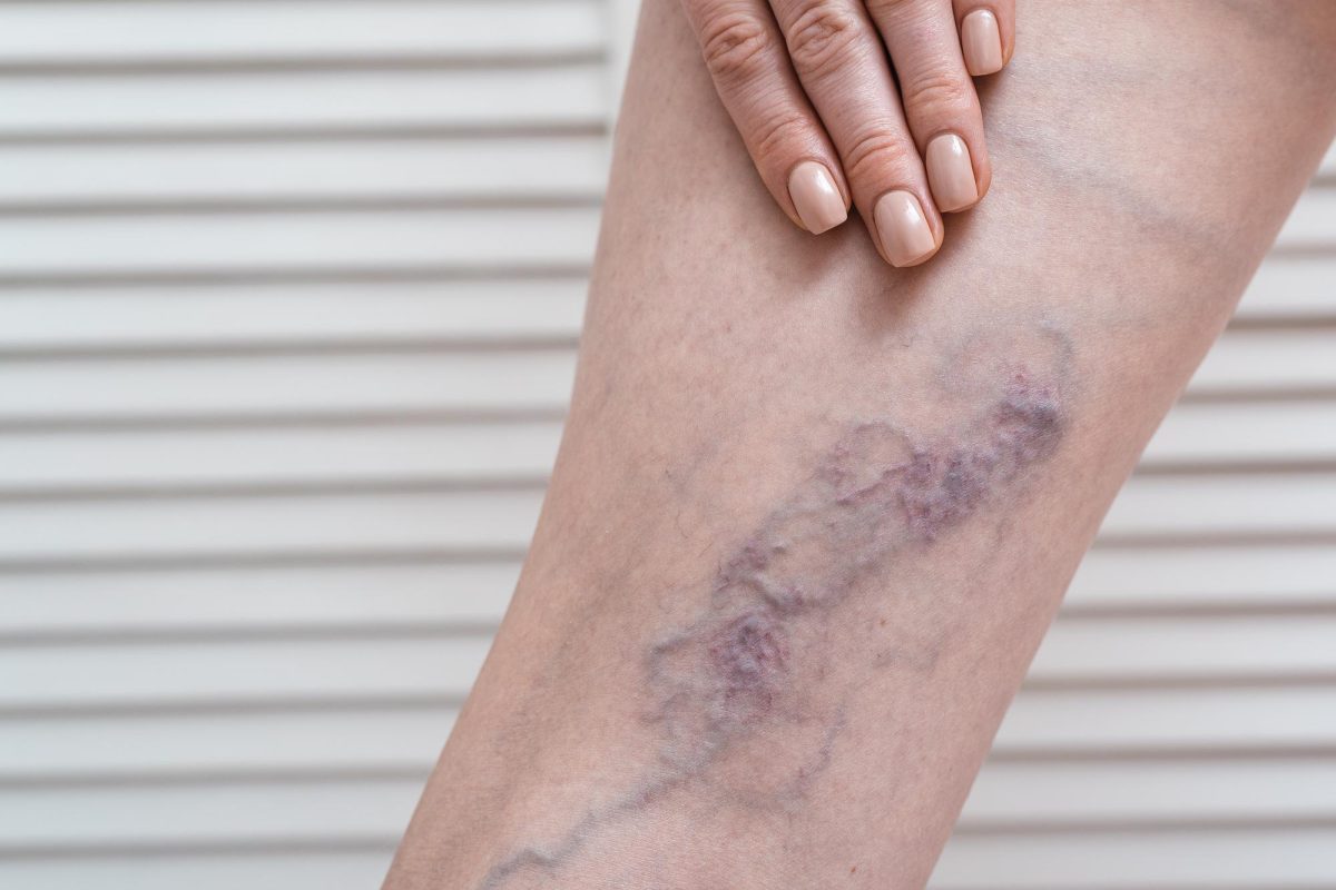 Spider veins treatment in Mumbai