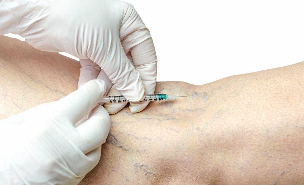 Varicose Veins Treatment in Mumbai