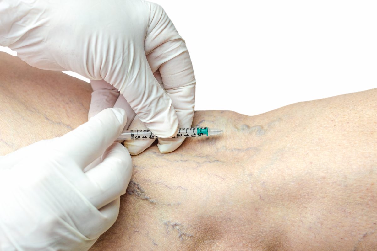 Varicose Veins Treatment in Mumbai