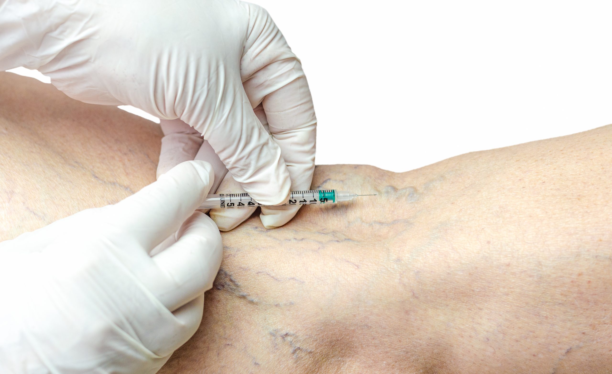 Varicose Veins Treatment in Mumbai