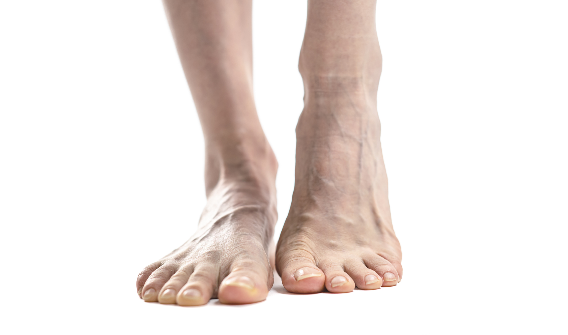 Best Shoes for Varicose Veins