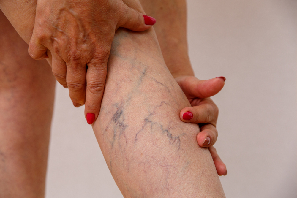 Deep Vein Treatment