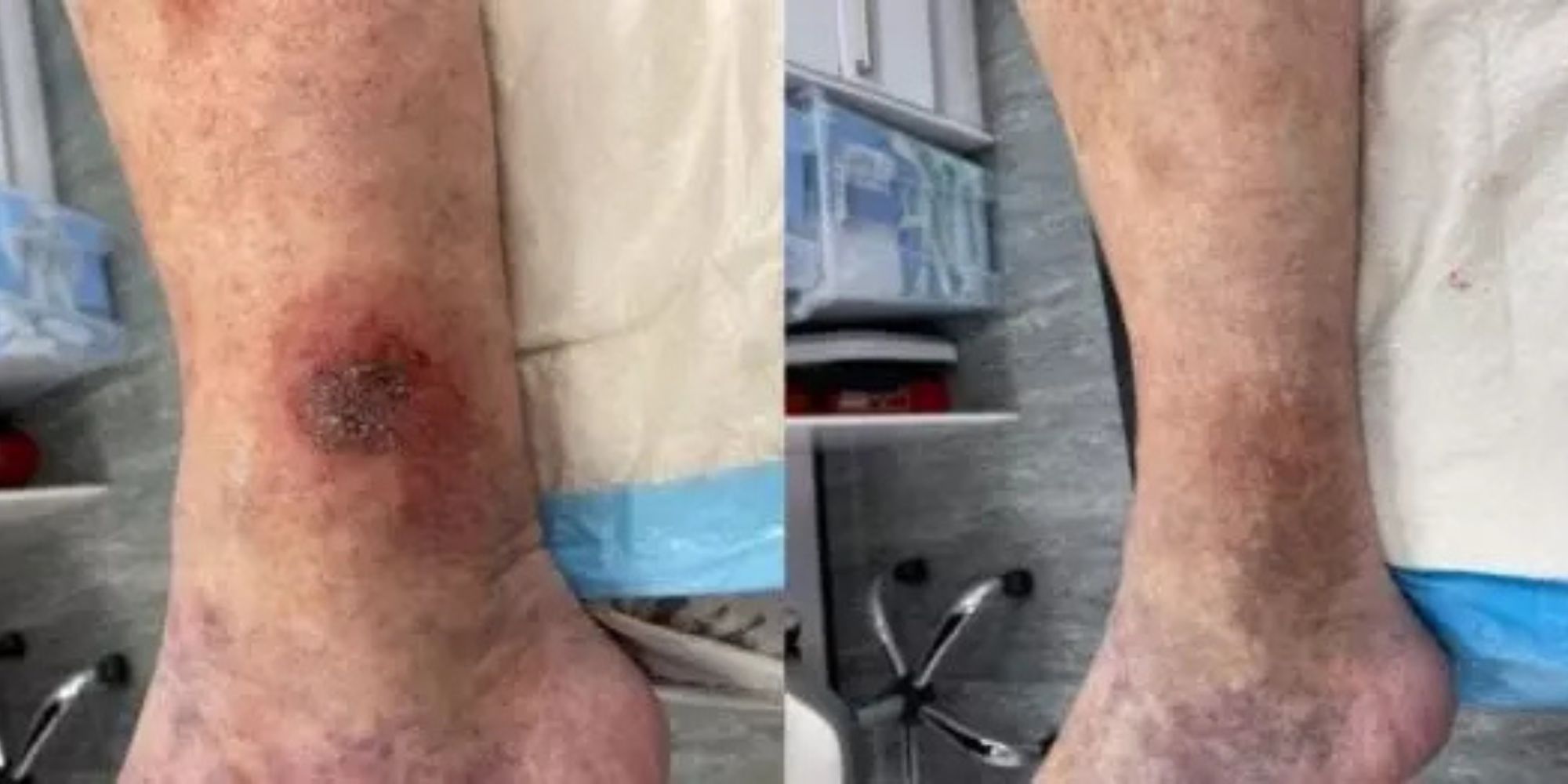 Laser Treatment for Venous Leg Ulcer