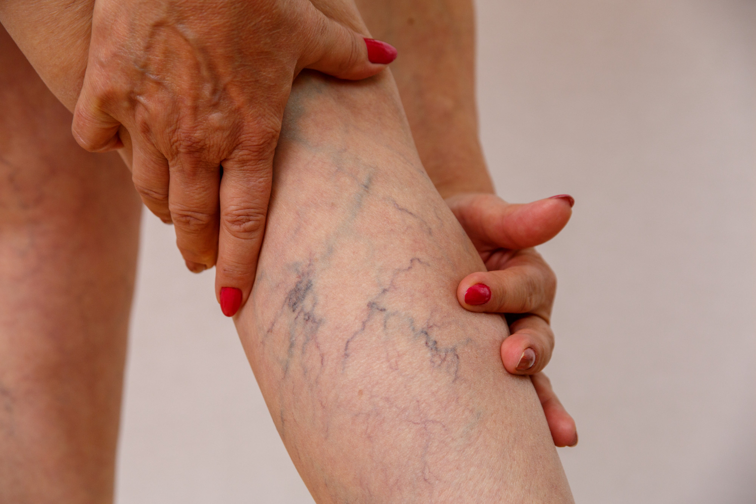 Laser Treatments for Spider Veins Laser Treatments for Spider Veins