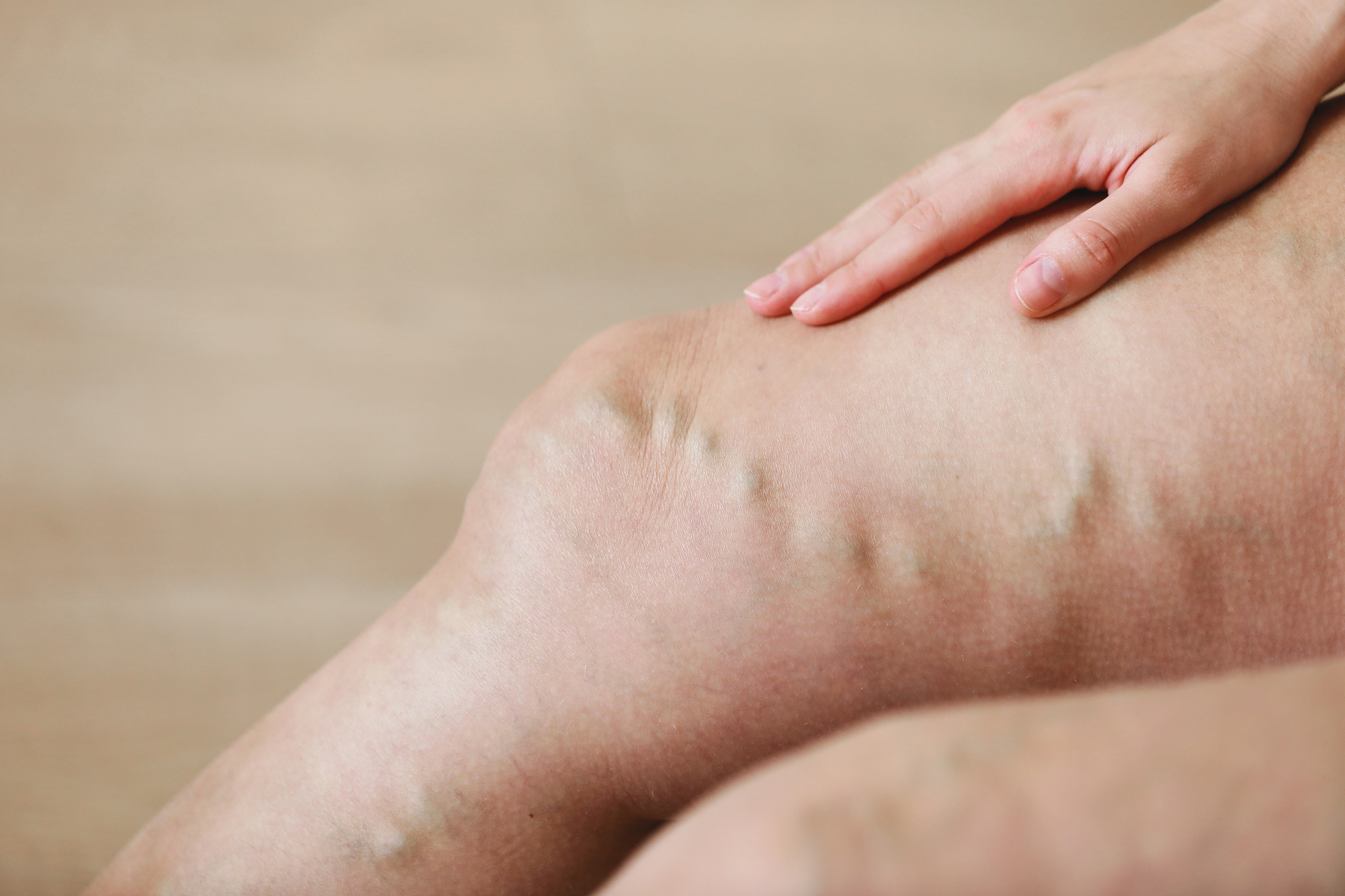 varicose veins