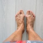 Varicose veins