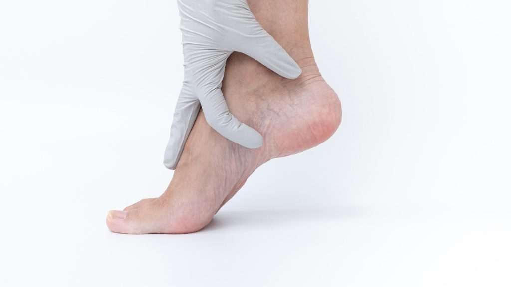 Varicose Veins Can Lead to Venous Leg Ulcers