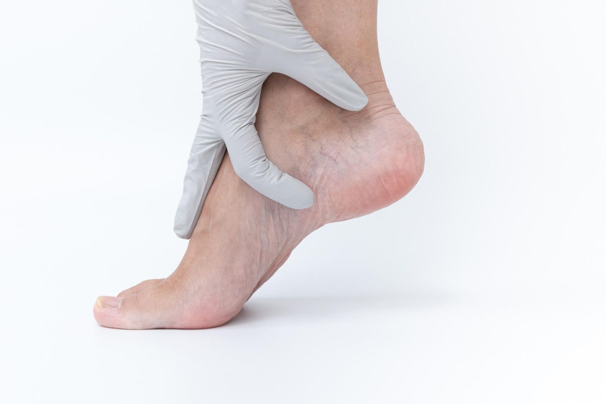 Varicose Veins Can Lead to Venous Leg Ulcers