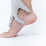 Varicose Veins Can Lead to Venous Leg Ulcers