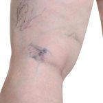 Recurrent varicose veins