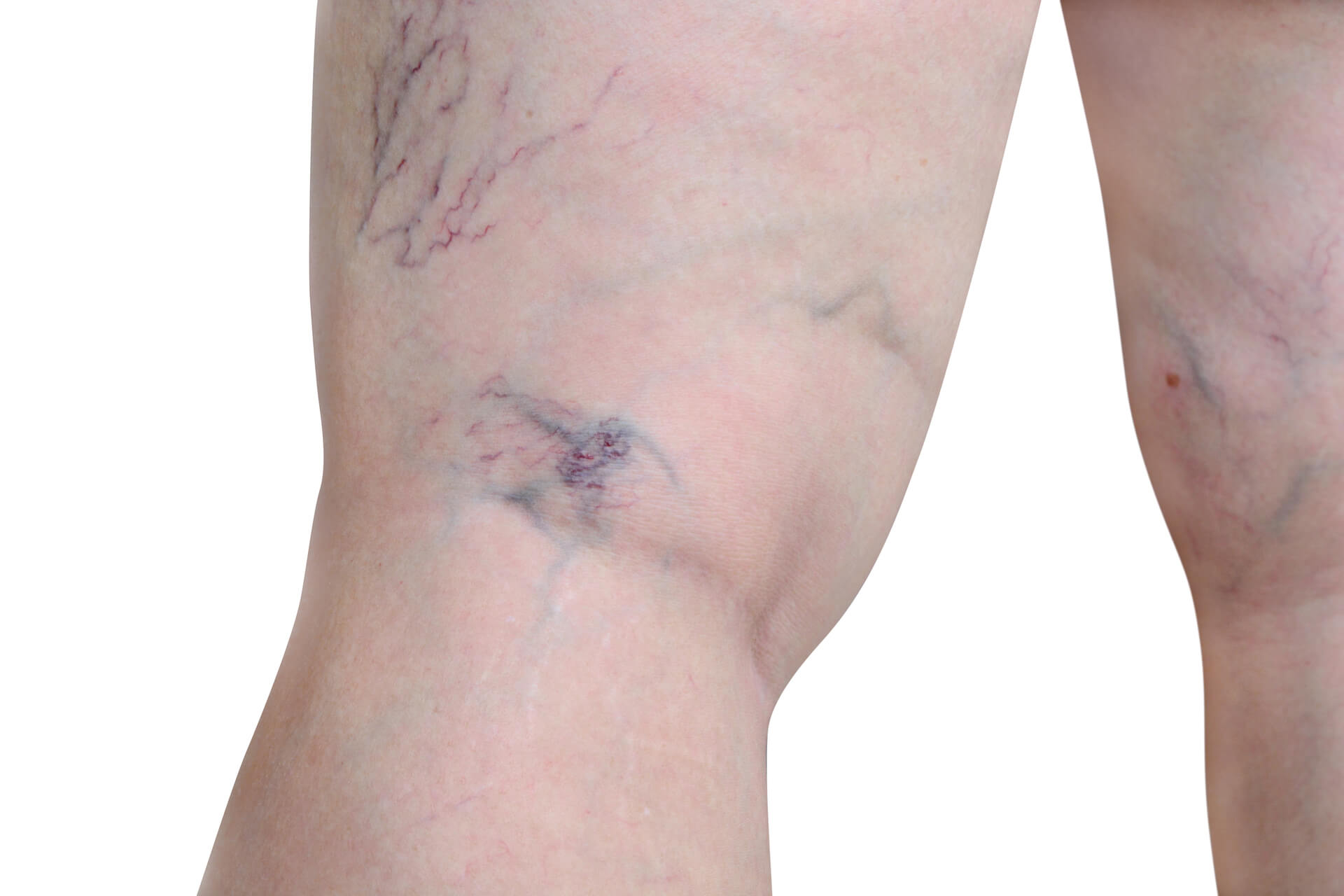 Recurrent varicose veins