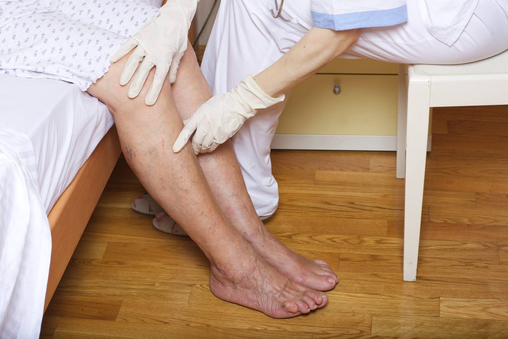 varicose veins
